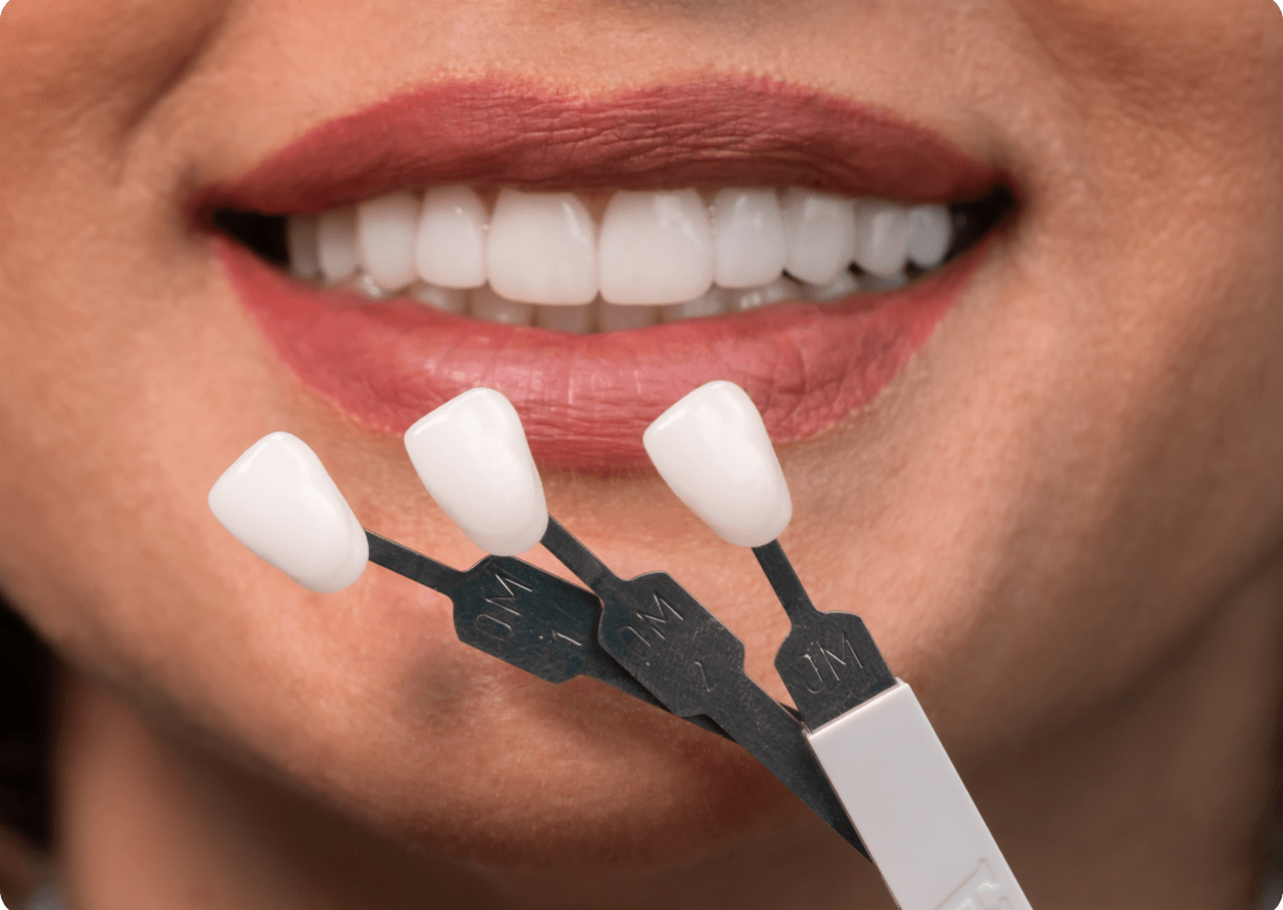 Fitting Process Image - The London Smile Clinic