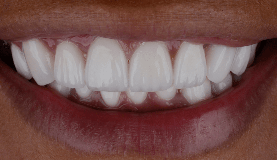 milestone-after Smile After Image