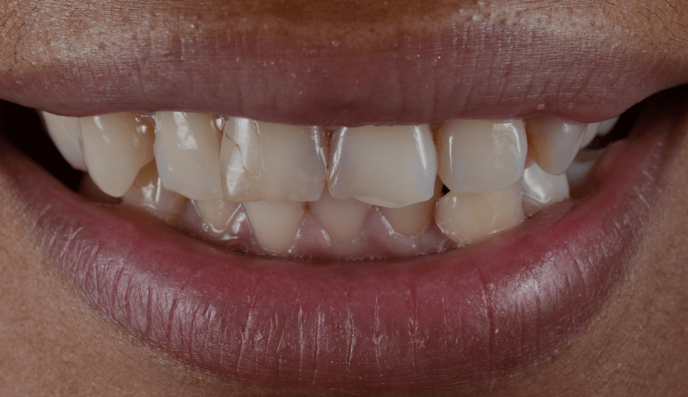 milestone-before Smile Before Image